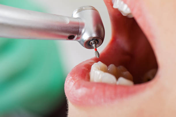 Best Chipped Tooth Repair Near Me  in Breese, IL